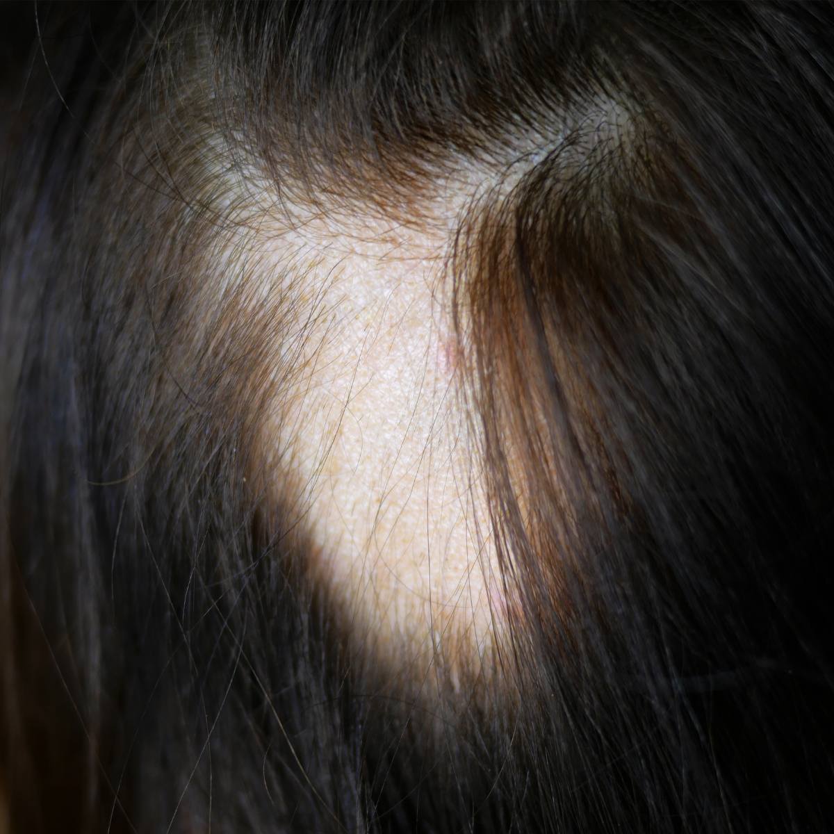 Male and Female Pattern Baldness Understanding Androgenetic